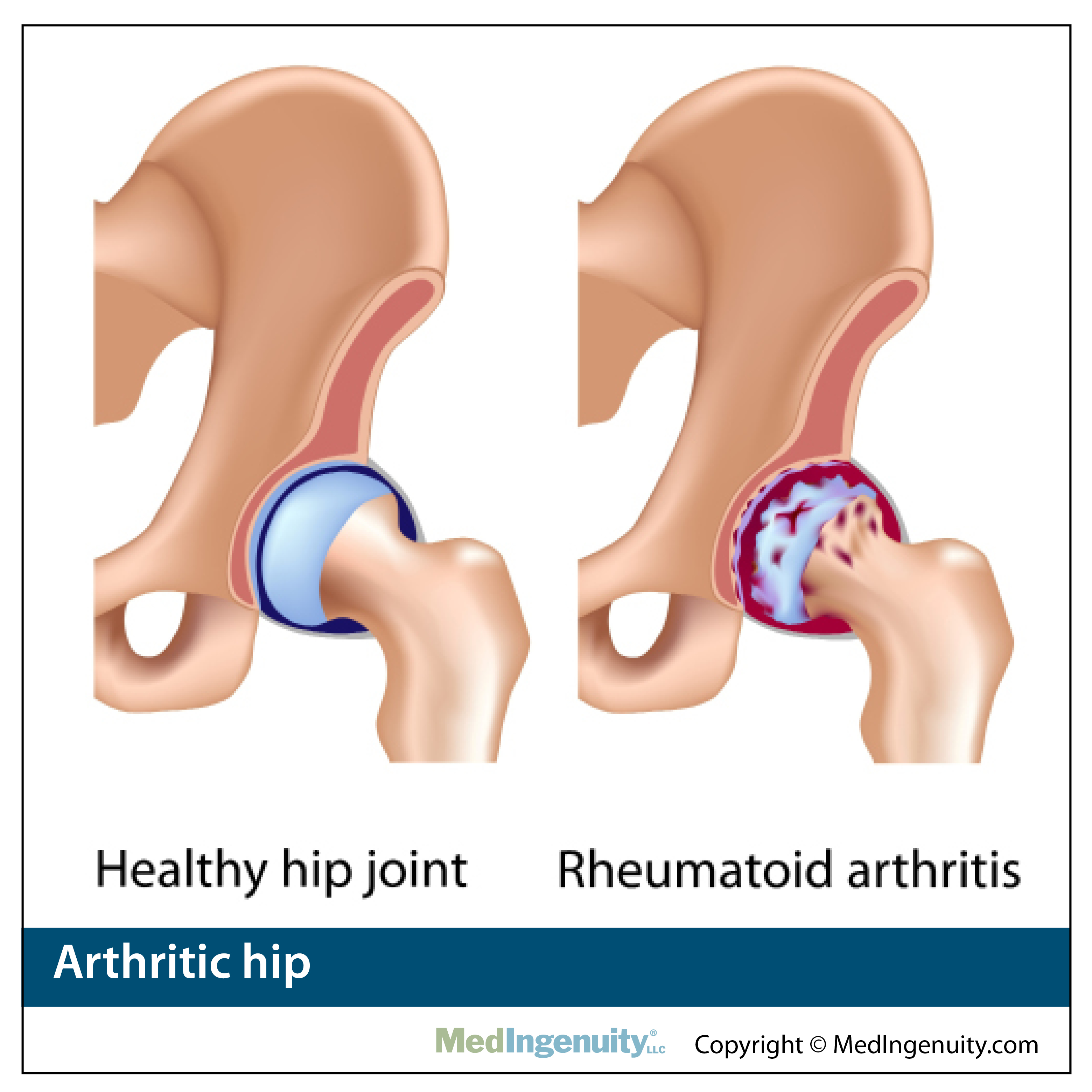 Arthritic Hip