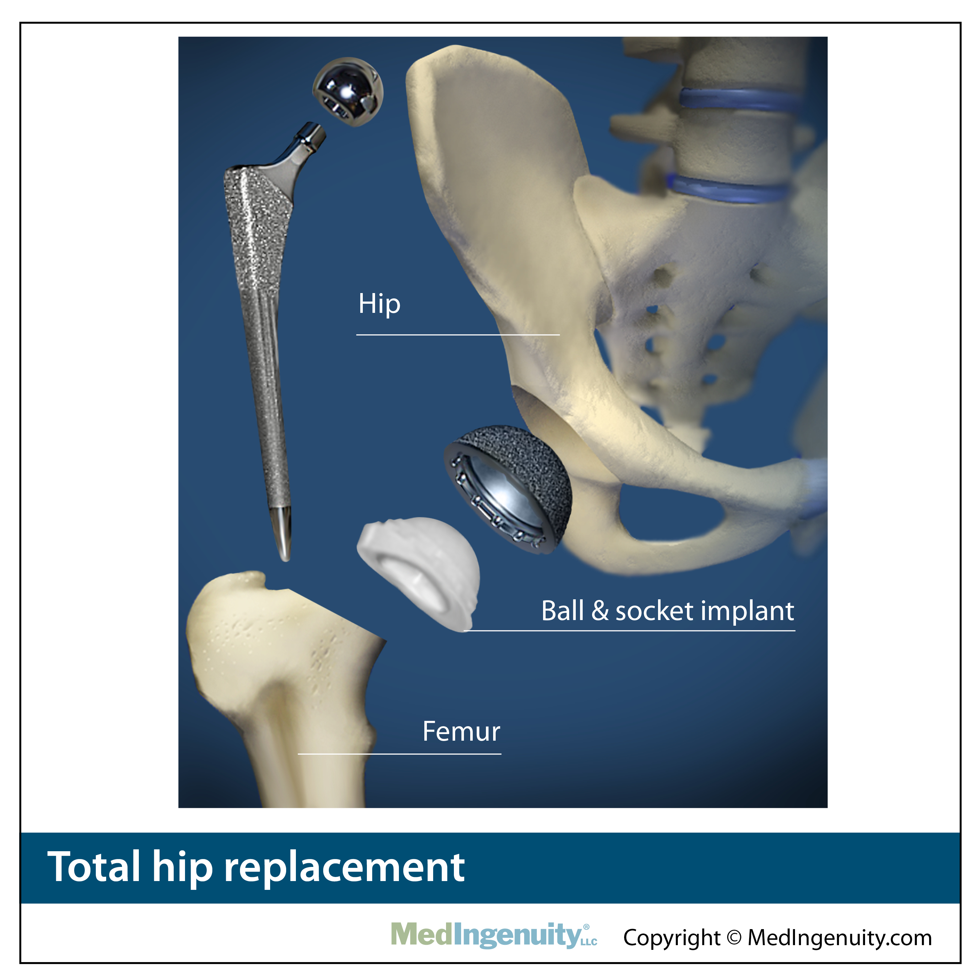 Northwest Hills Surgical Hospital Hip Pain