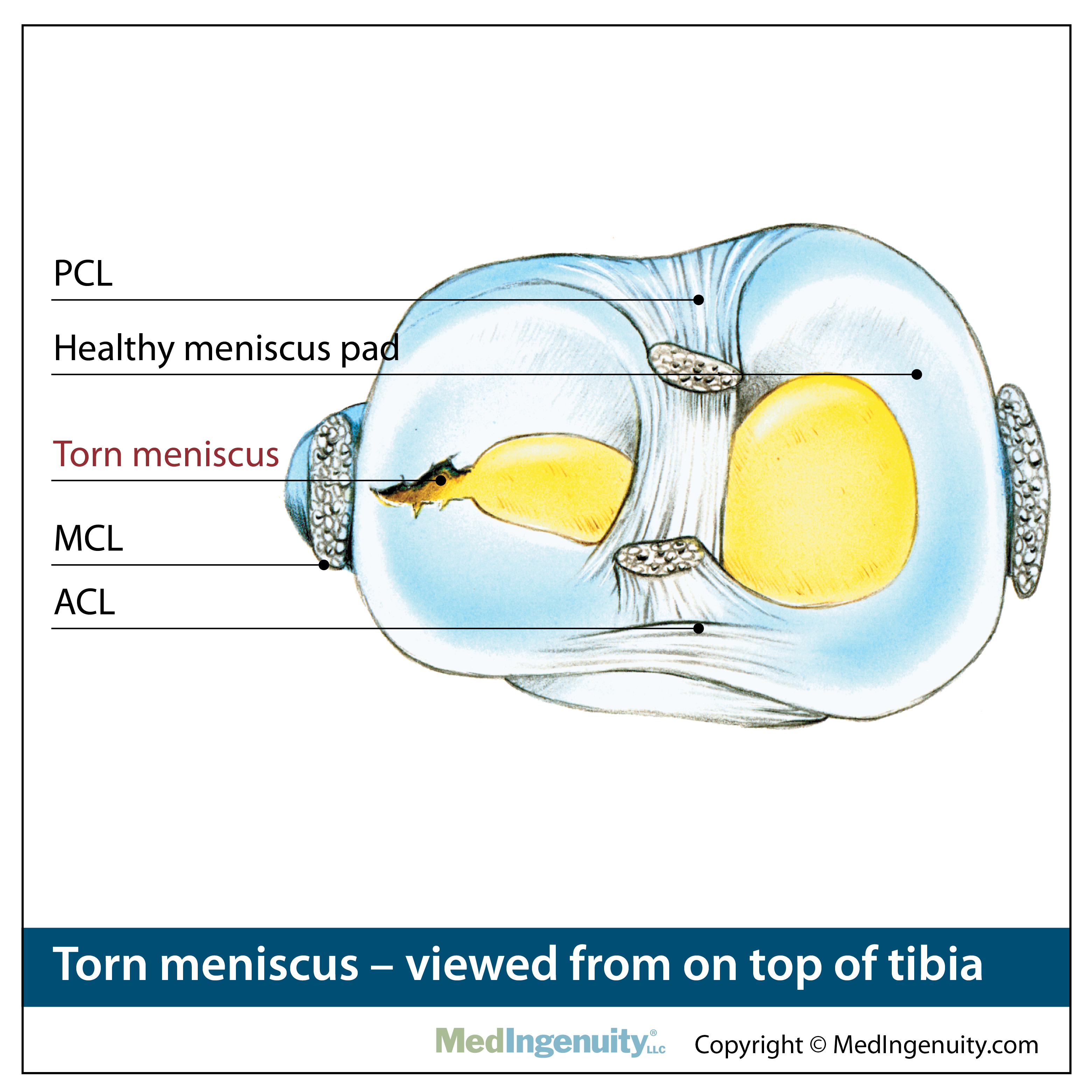 Torn Menicus
