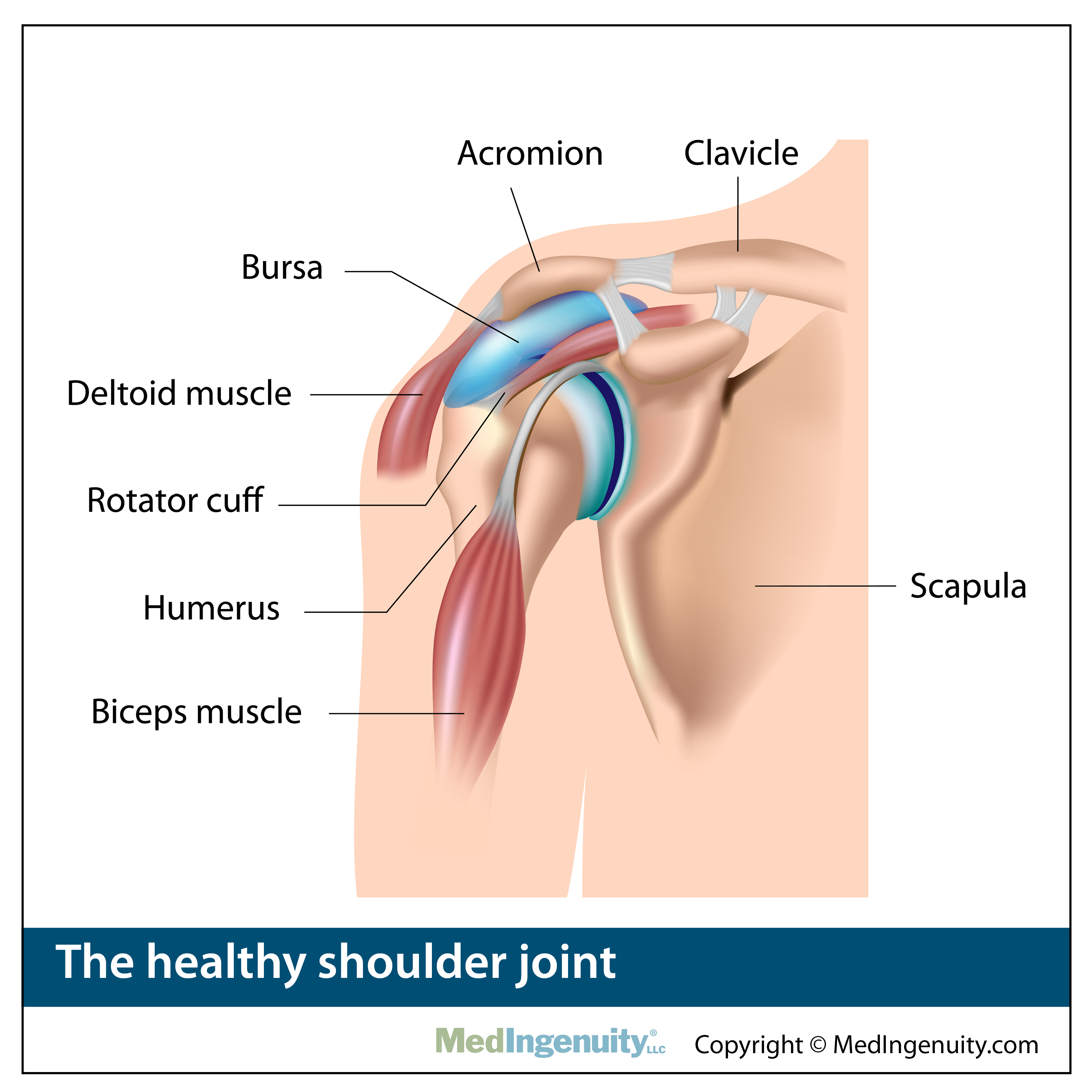 Torn Shoulder