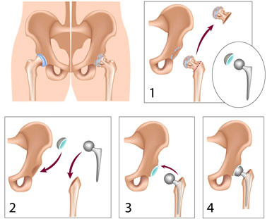 steps of hip replacement surgery